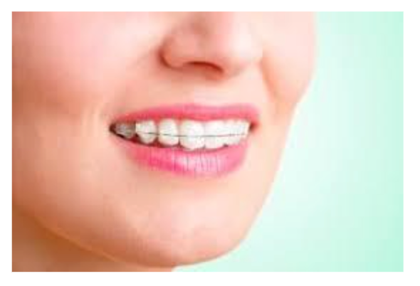 Orthodontic Treatment in Kalyan Nagar